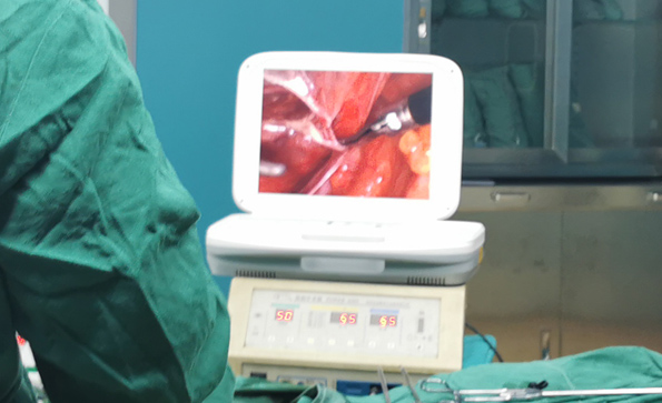 宮腔鏡和腹腔鏡有什么不同？