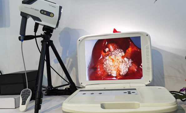 陰道鏡：在陰道鏡下如何做宮頸囊腫？