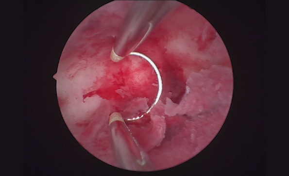 宮腔鏡系統(tǒng)包括哪些設(shè)備？如何消毒？